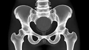 découvrez ce qu'est une métastase osseuse et apprenez à comprendre la signification de la tache noire observée sur une radiographie du bassin.